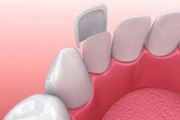 Dental-Veneers-2