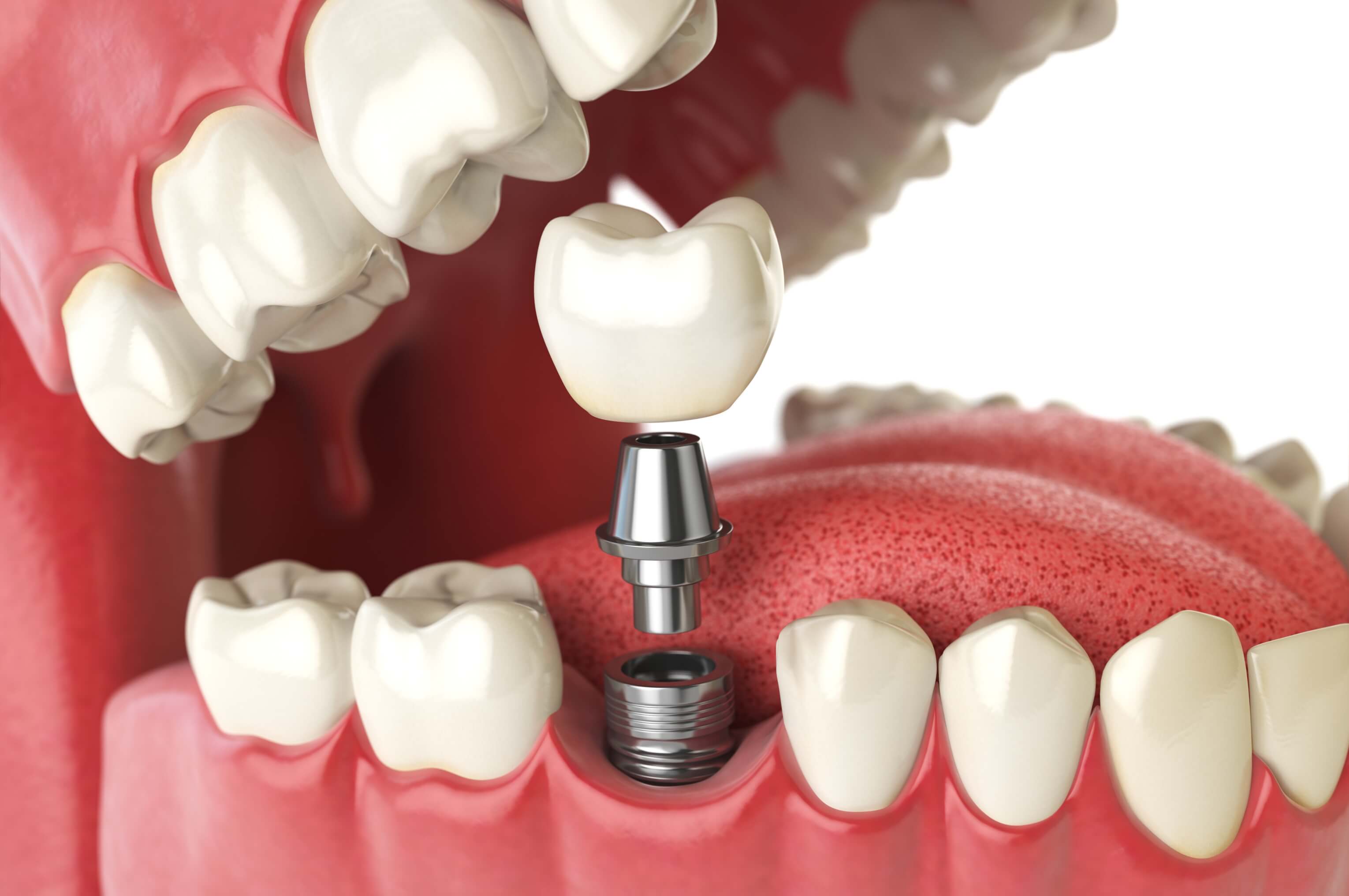 An Introduction to Dental Implants